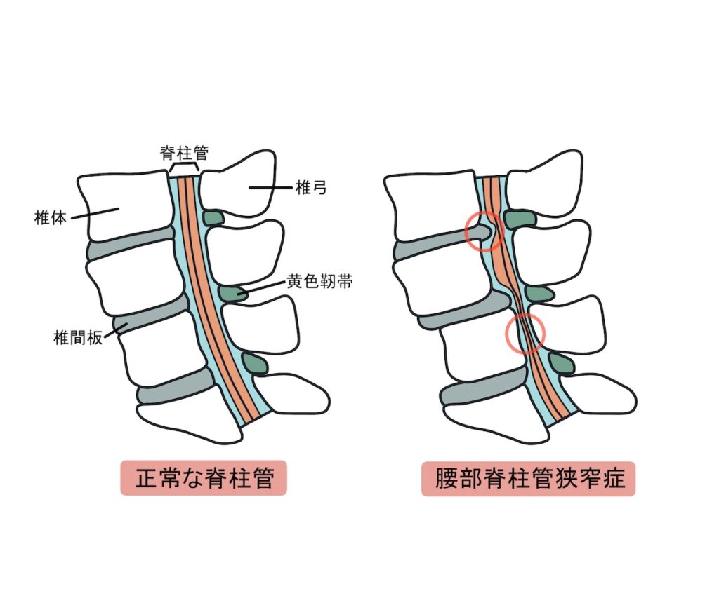 腰部脊柱管狭窄症の図解